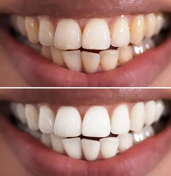 28763 teeth whitening procedure