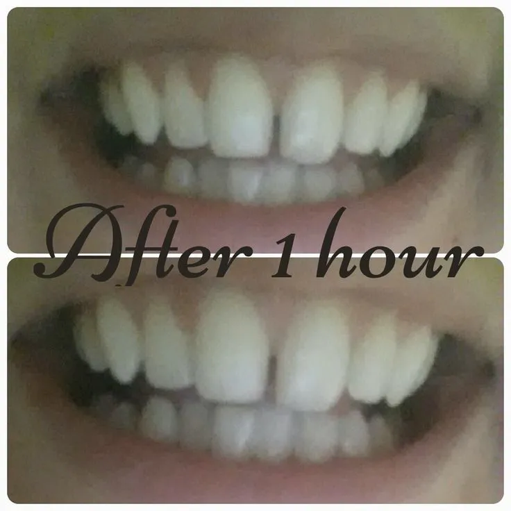 28764 advanced whitening techniques