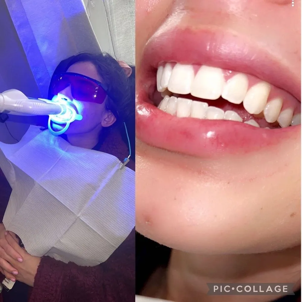 28770 teeth whitening riverside before after