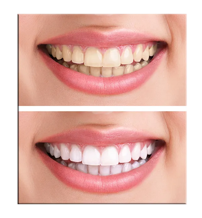 28770 teeth whitening sensitivity