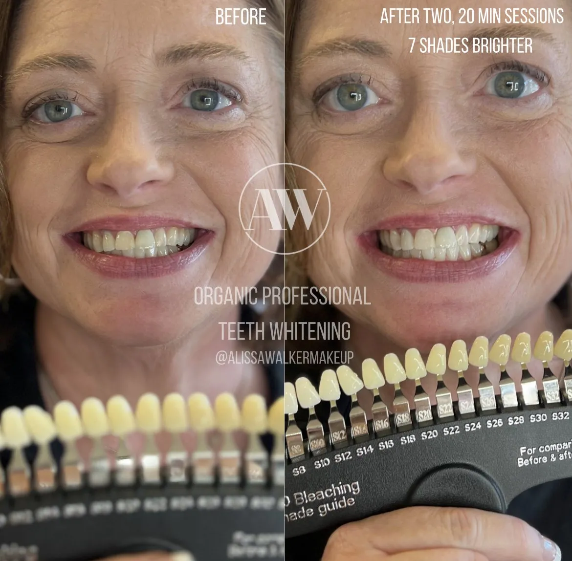 28774 teeth whitening kalamazoo 4