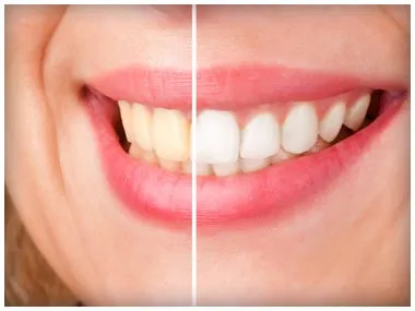 28774 teeth whitening kalamazoo 6