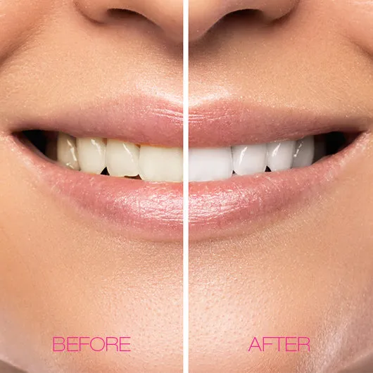 28777 customized teeth whitening peoria