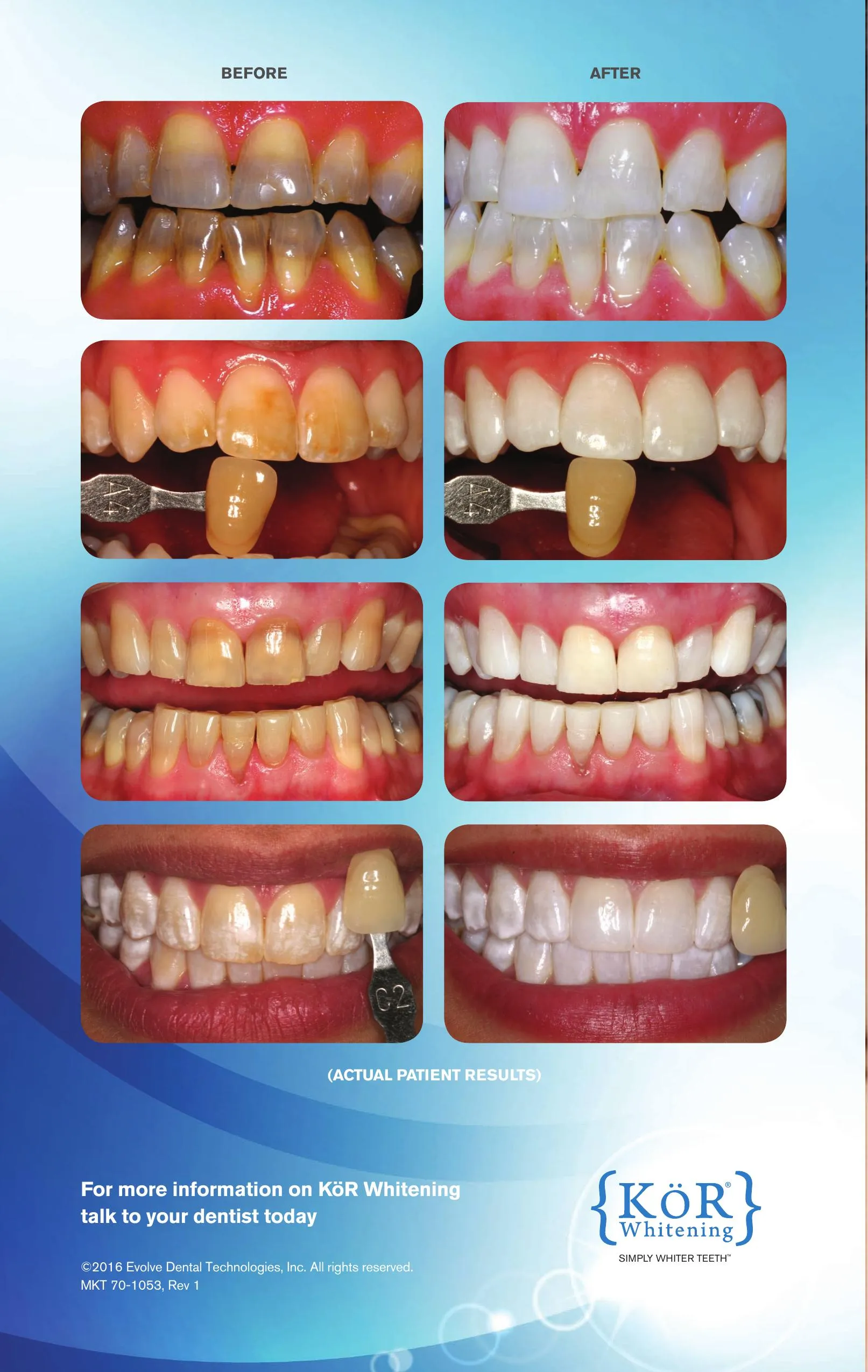 28779 fluoride treatment