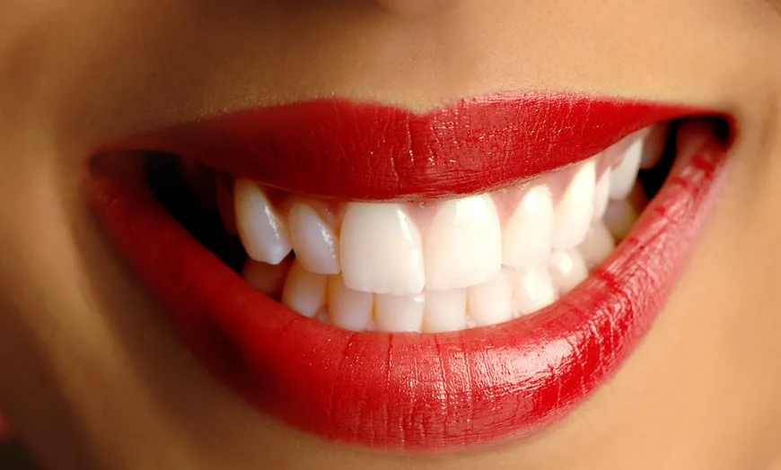 28781 at home teeth whitening