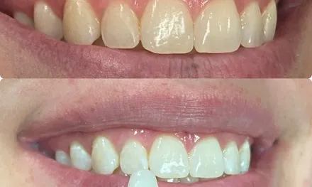 28781 teeth sensitivity