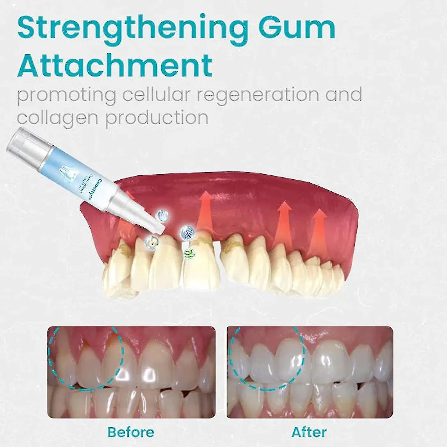 28786 teeth whitening gel irritation