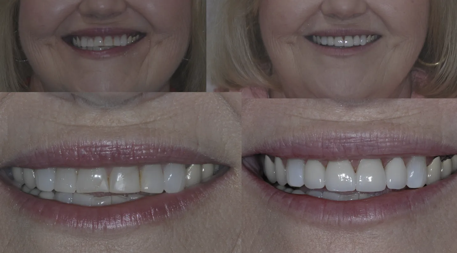 28793 avoid teeth staining foods