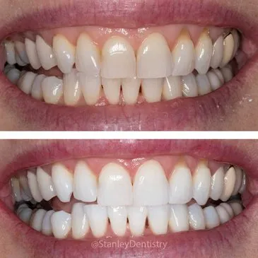 28798 zoom vs kor whitening options