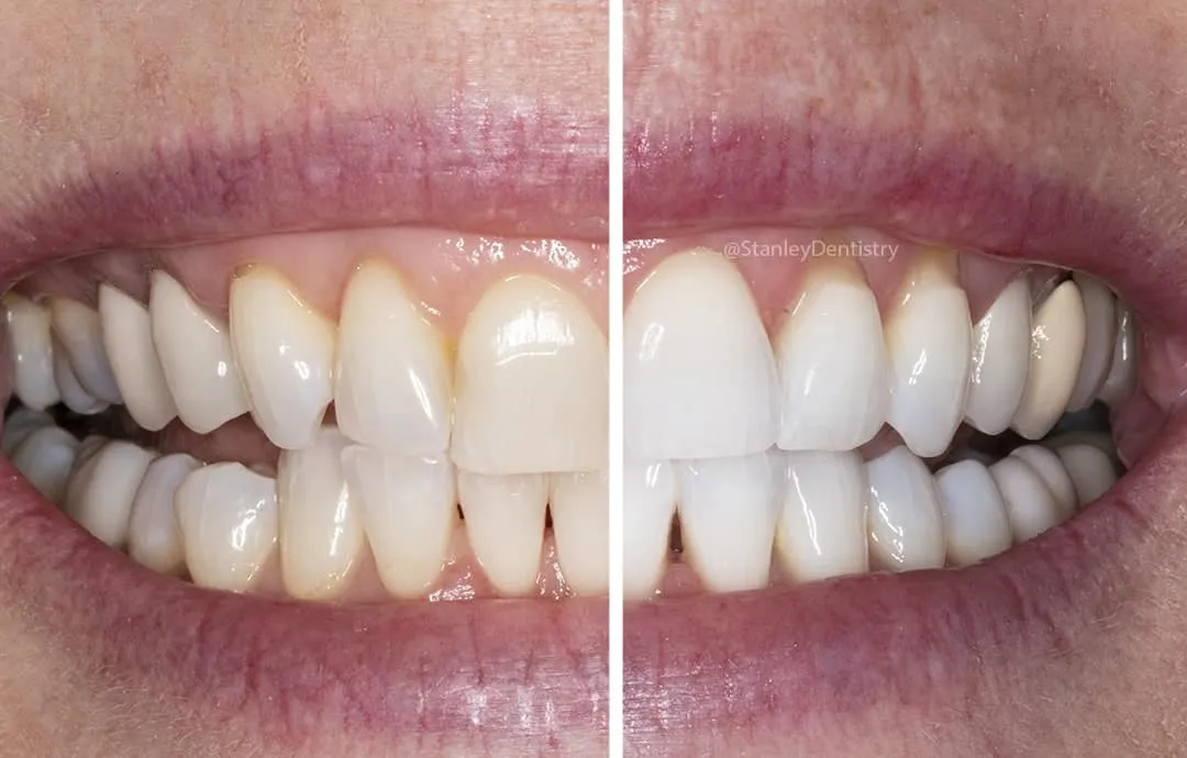28798 zoom whitening procedure