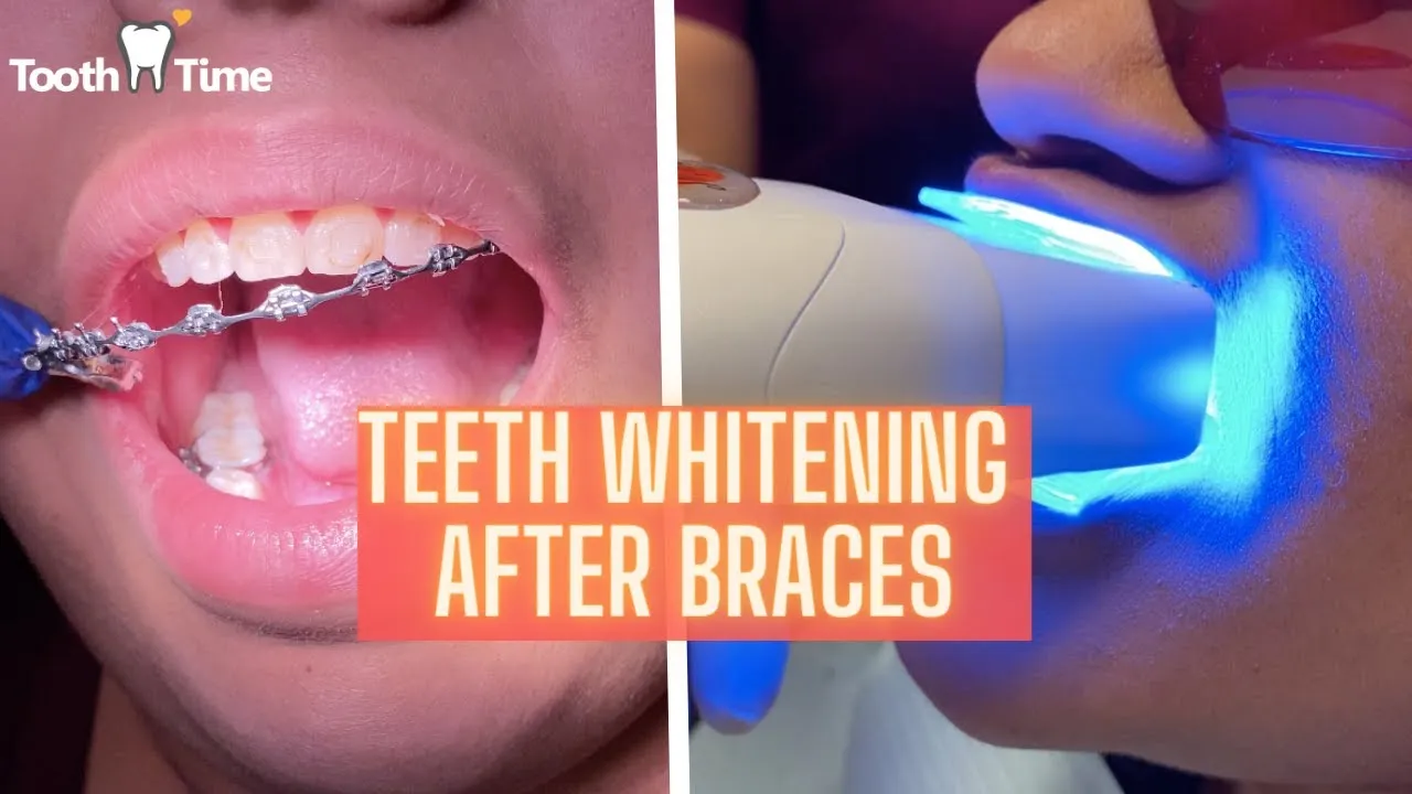 28801 professional teeth whitening