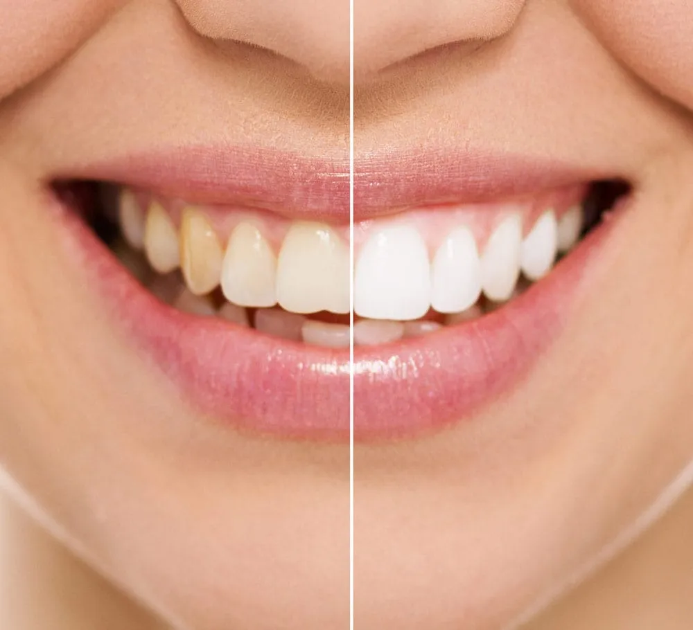 28809 portland tooth whitening office