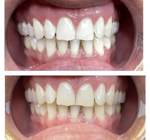 28809 tooth whitening benefits