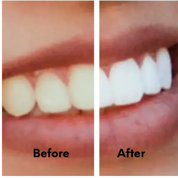 28809 tooth whitening cost