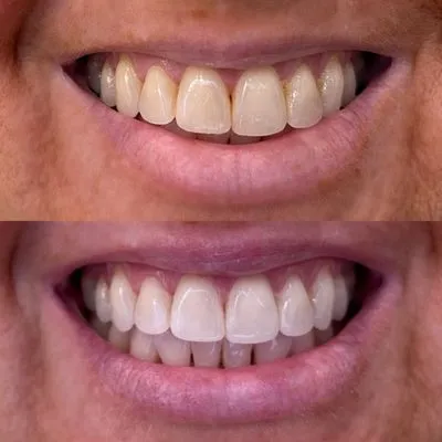 28809 tooth whitening methods