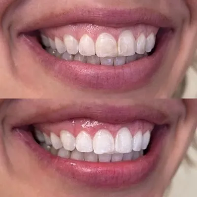 28809 tooth whitening portland smile