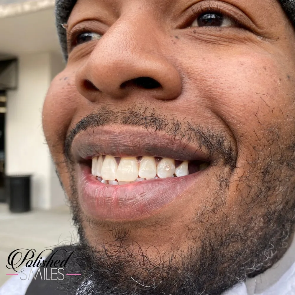 28814 in office teeth whitening