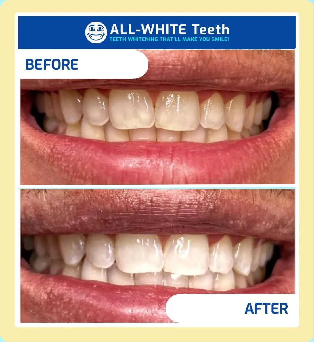 28814 take home teeth whitening