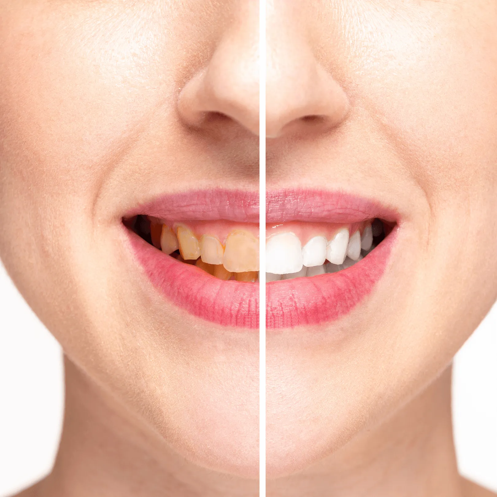 28814 teeth whitening options