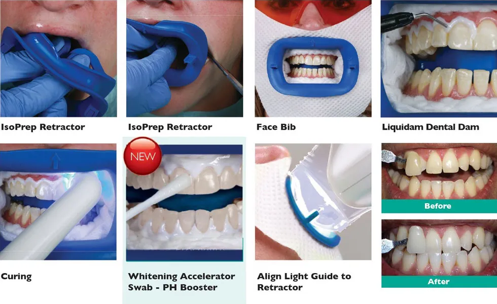 28815 teeth whitening cost