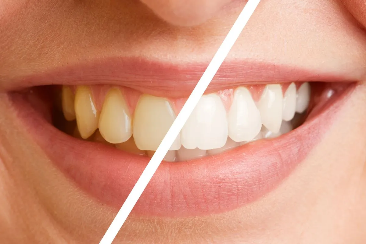 28815 teeth whitening procedure