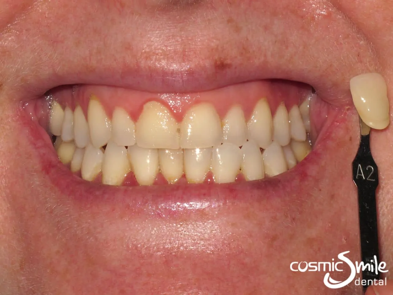 28815 teeth whitening results