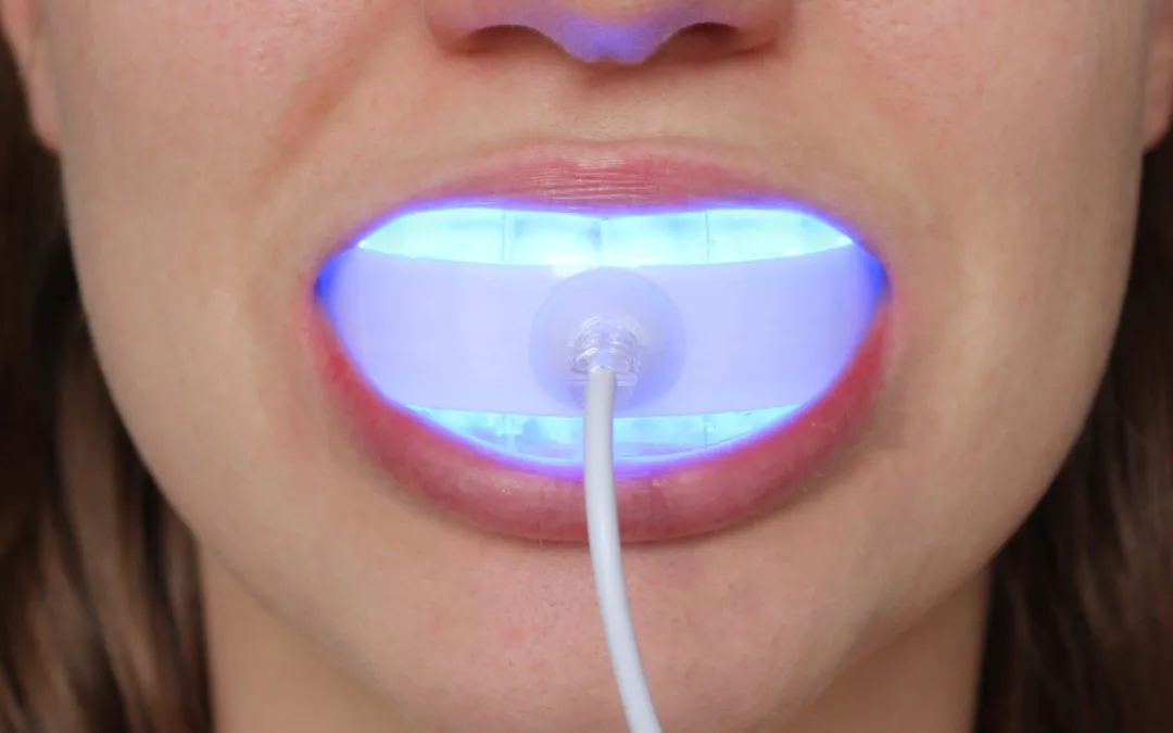 28820 alternatives to teeth whitening lights