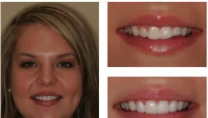 28827 in office teeth whitening