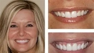 28827 teeth whitening greenville nc overview