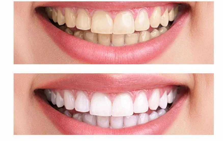 28831 teeth discoloration