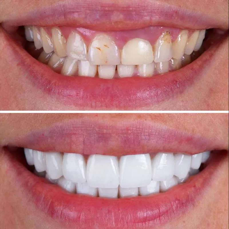 28834 oil pulling teeth