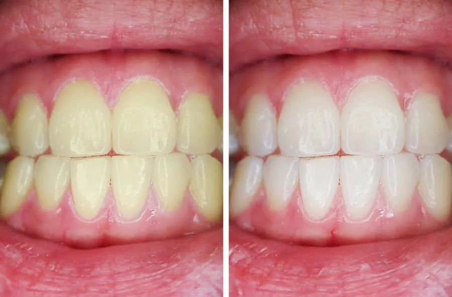 28834 teeth discoloration causes
