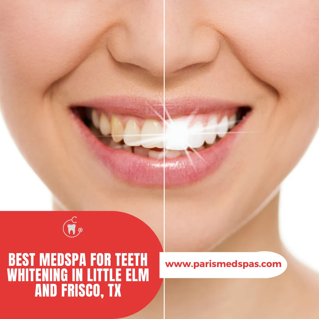 28835 at home whitening kits