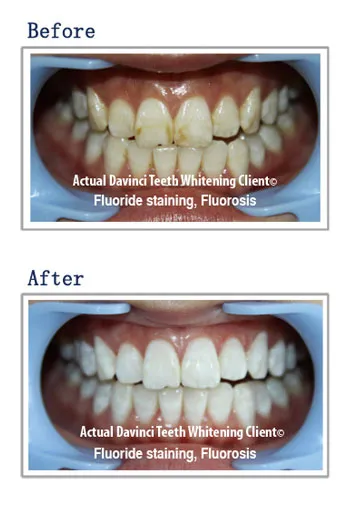 28836 da vinci process