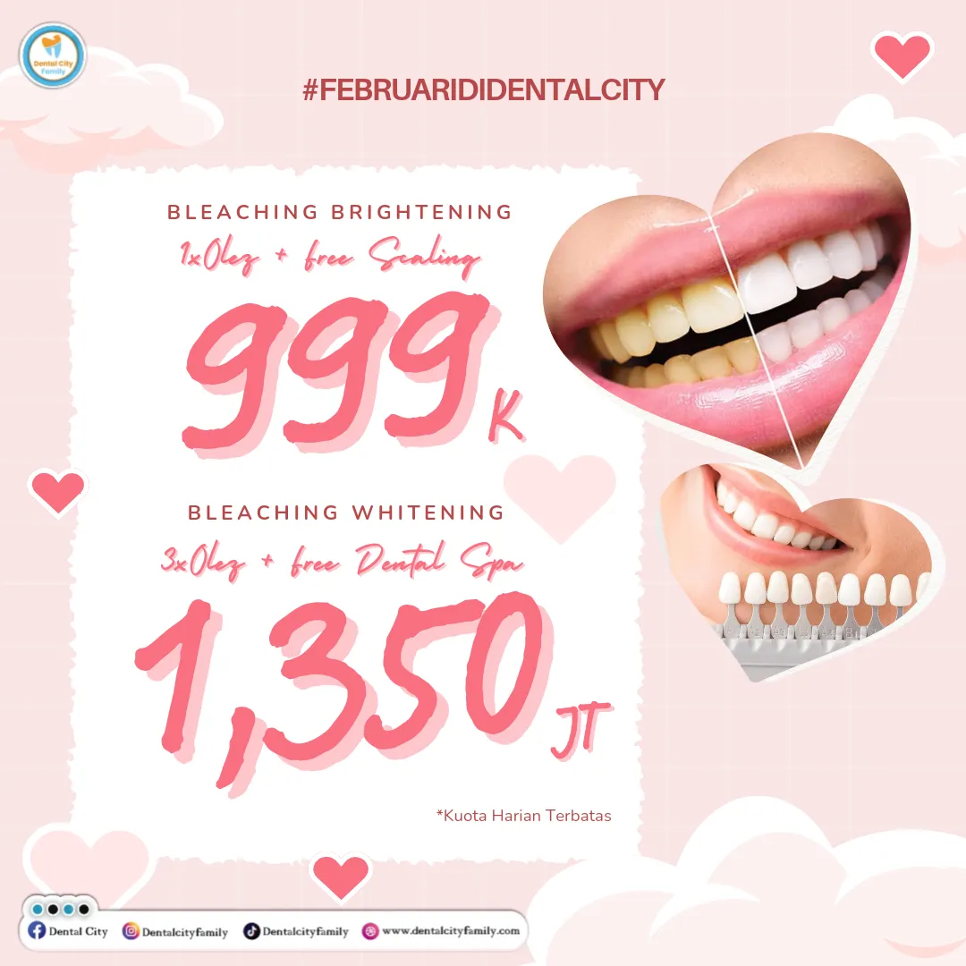 28840 in office teeth whitening