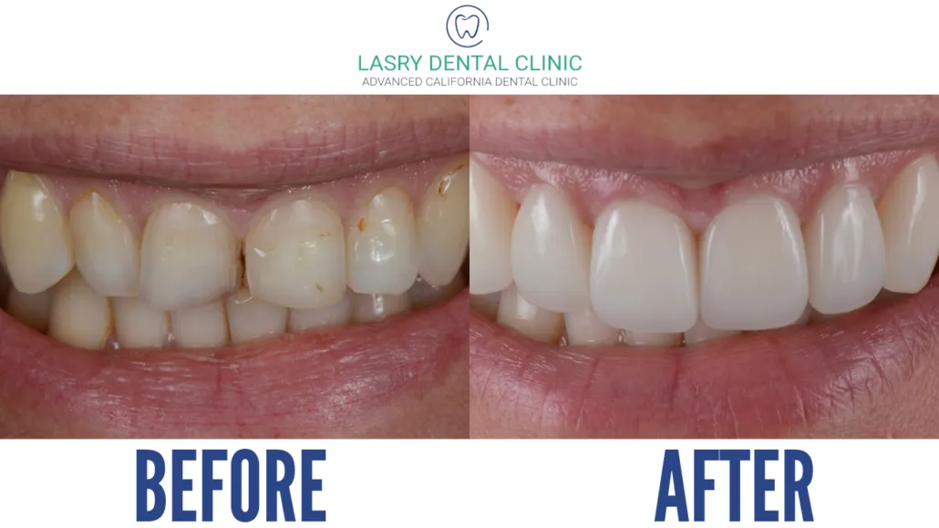 28841 tooth sensitivity after whitening