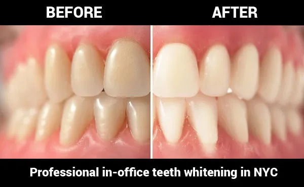 28843 teeth whitening kits