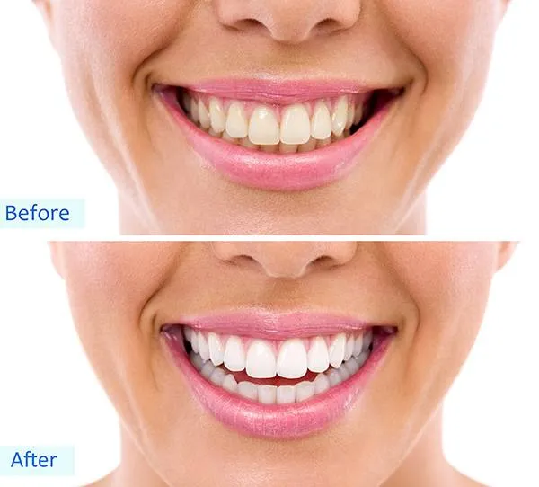 28845 at home teeth whitening