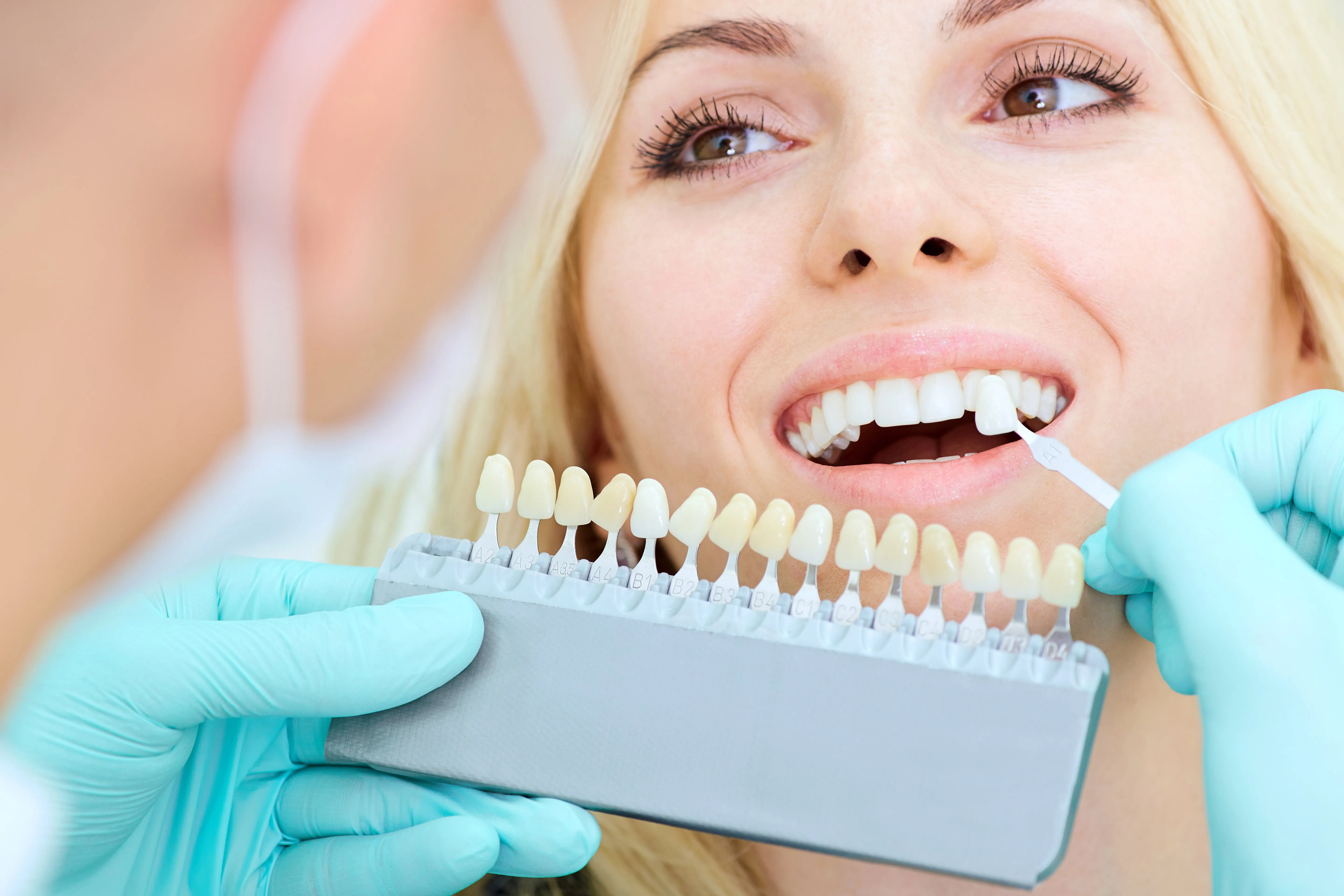 28845 teeth cleaning before whitening