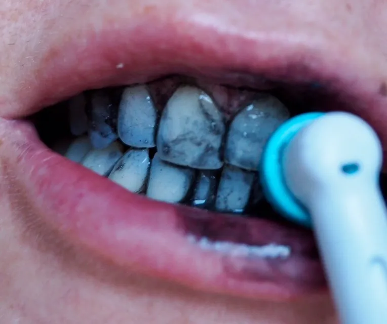 28856 charcoal teeth whitening cost