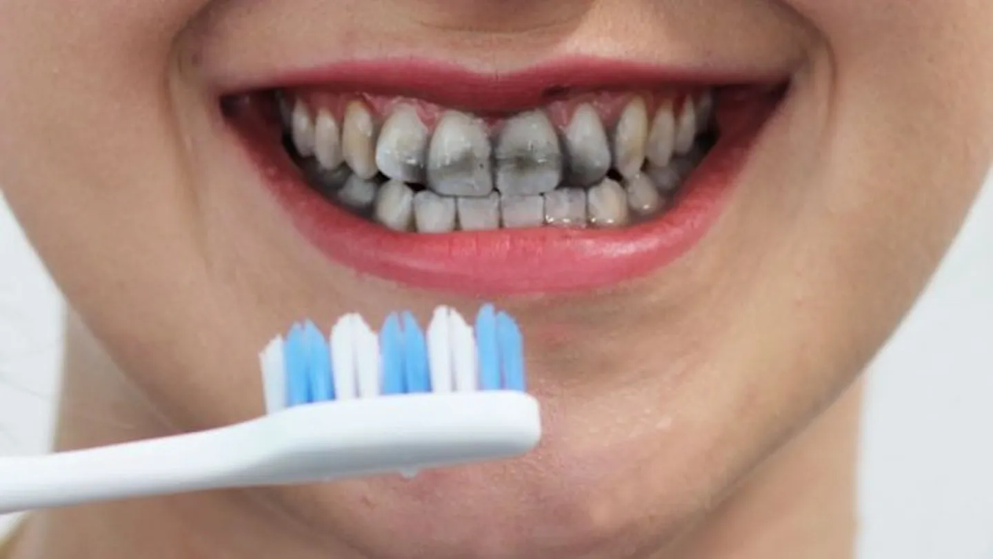 28856 dentist recommending teeth whitening