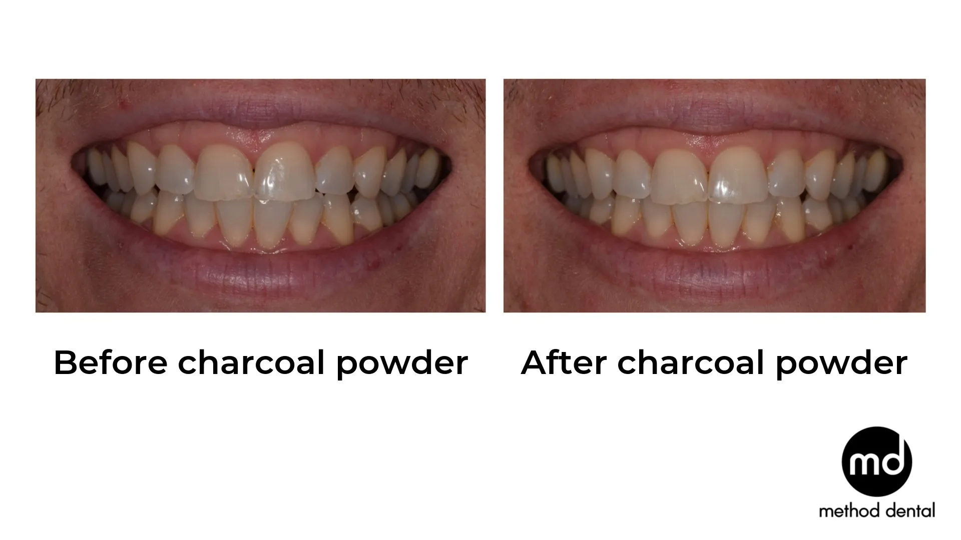 28856 teeth whitening results expectations