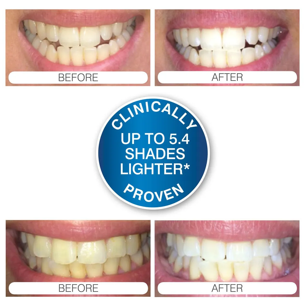 28858 teeth whitening fast results