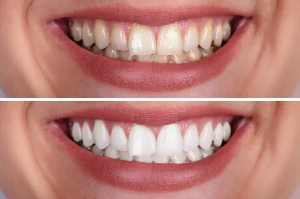 28860 bonding veneers