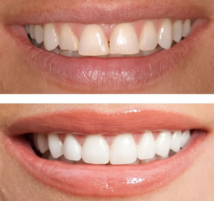 28862 at home teeth whitening