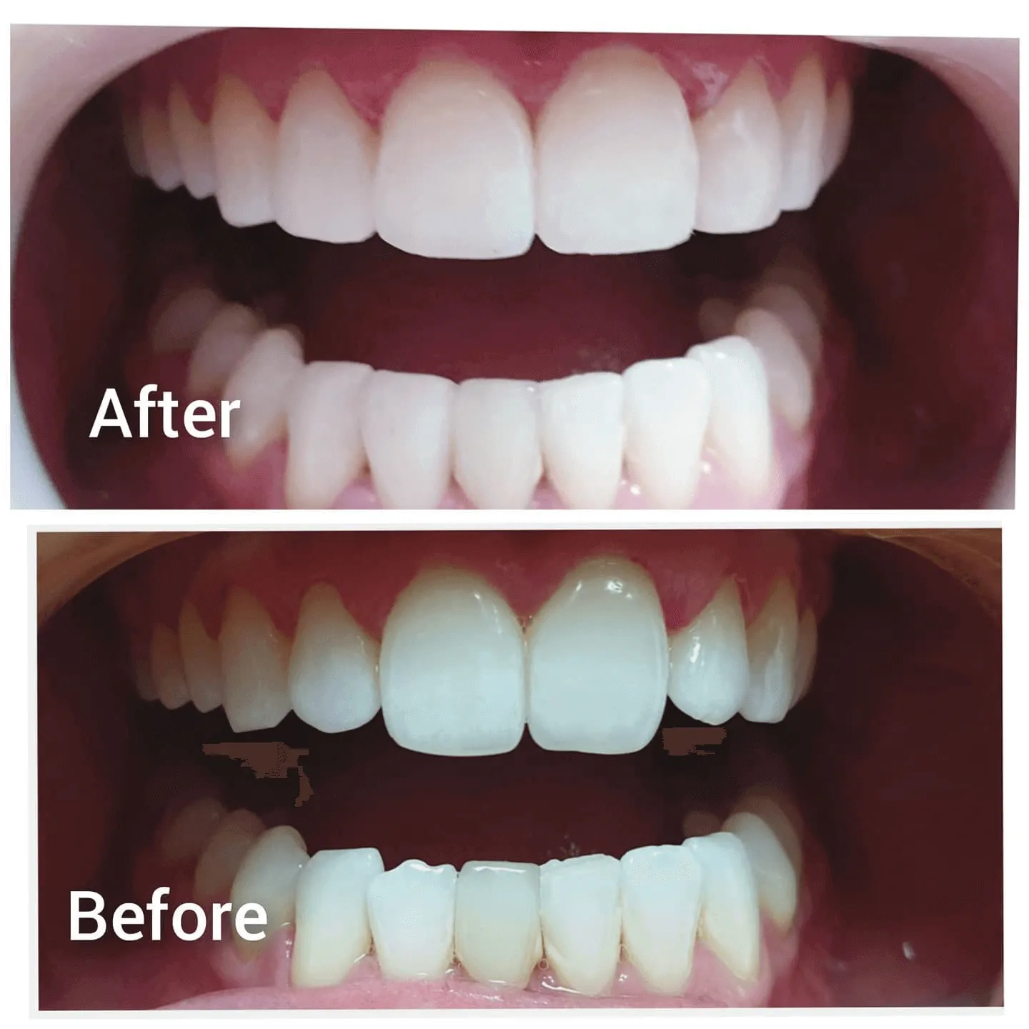28862 caring for whitened teeth