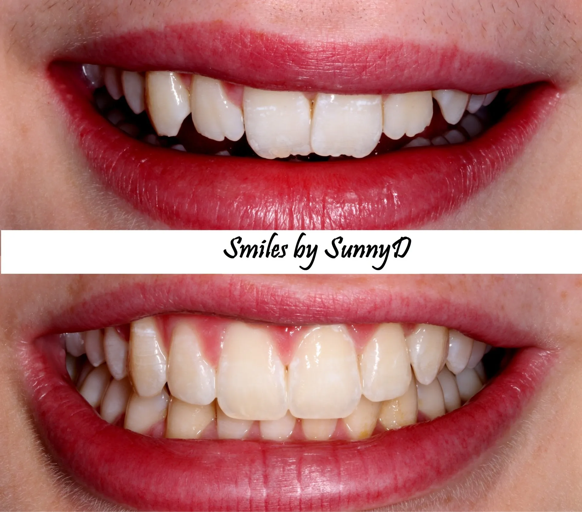 28862 maintaining dental bonding