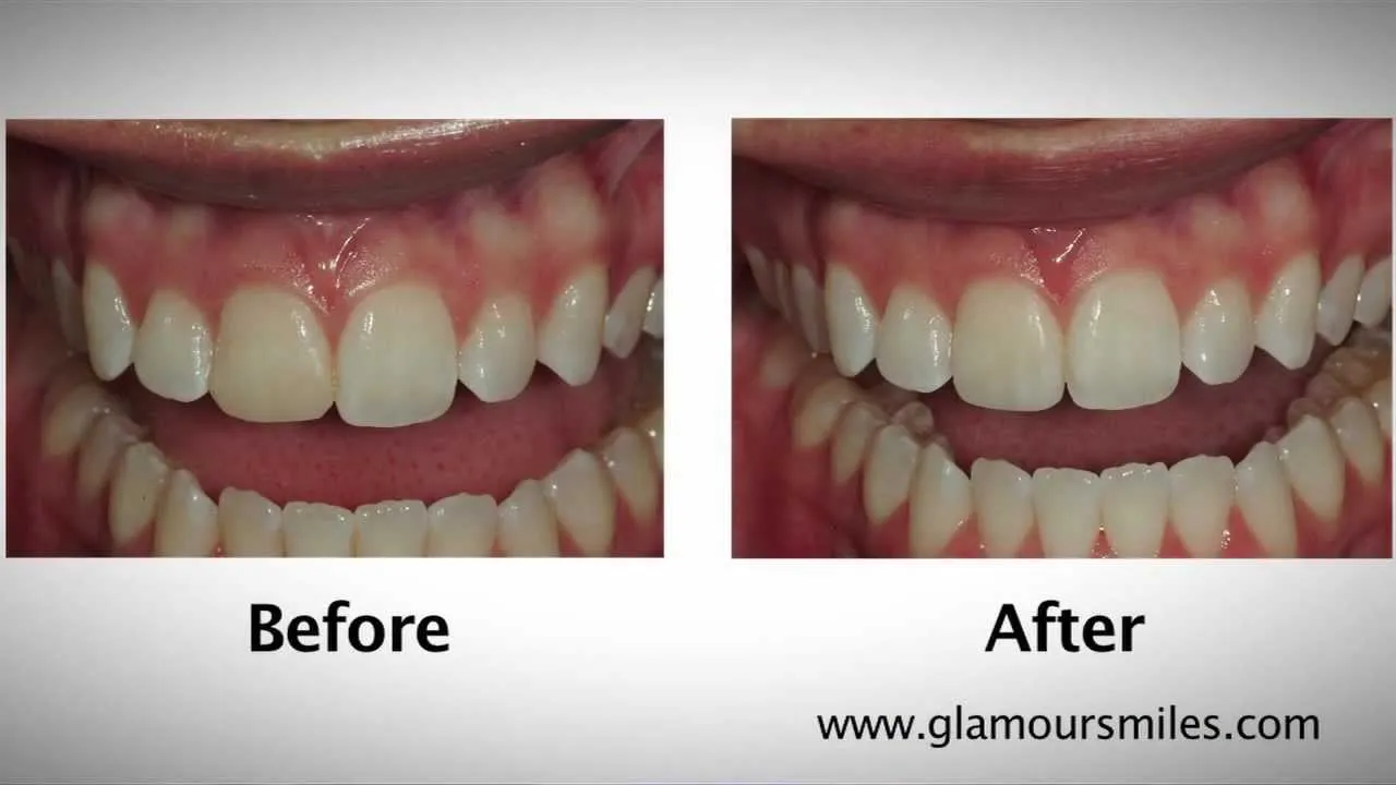 28862 professional teeth whitening