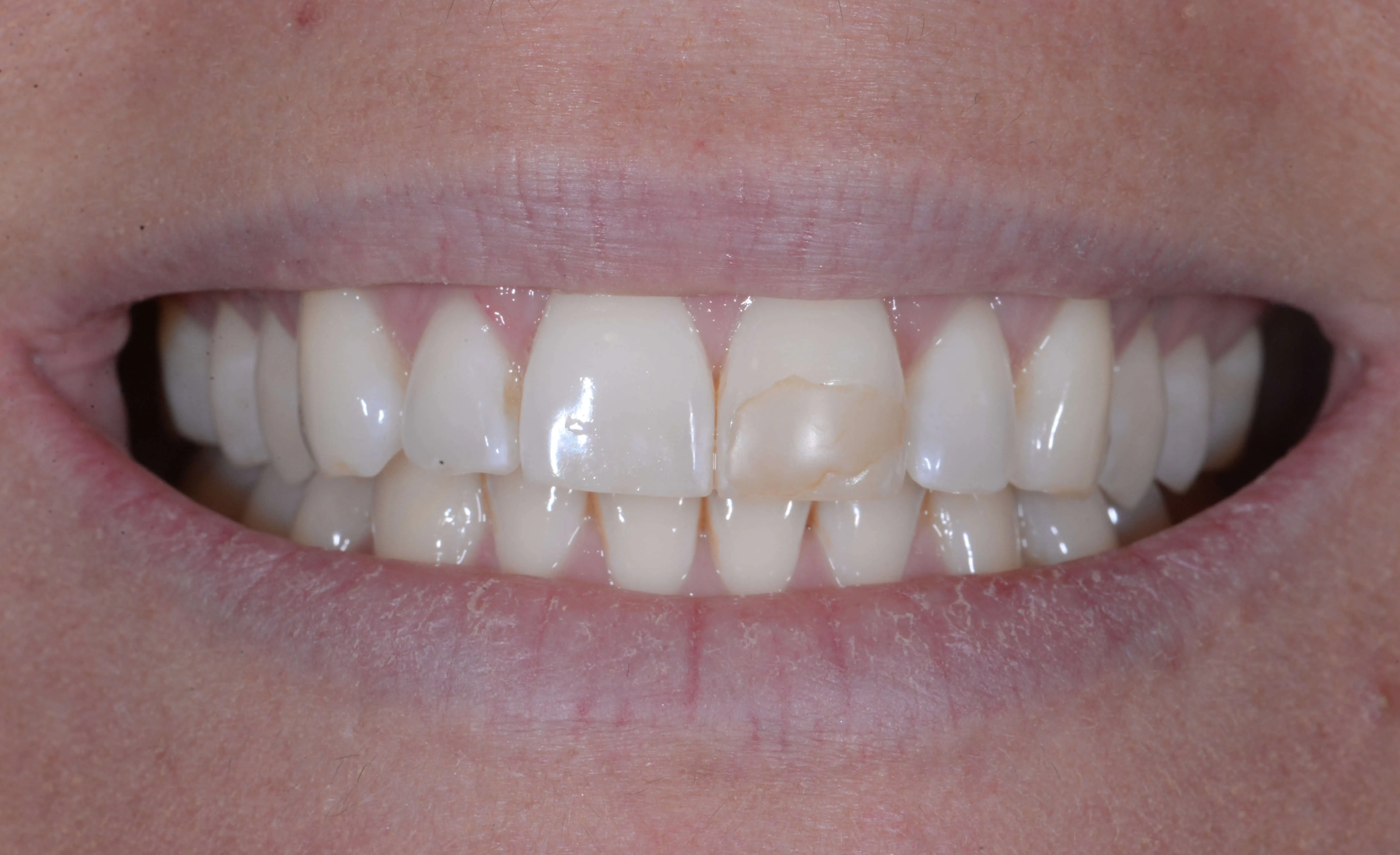 28862 teeth whitening and bonding overview