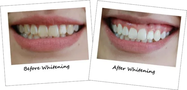 28866 teeth whitening before after